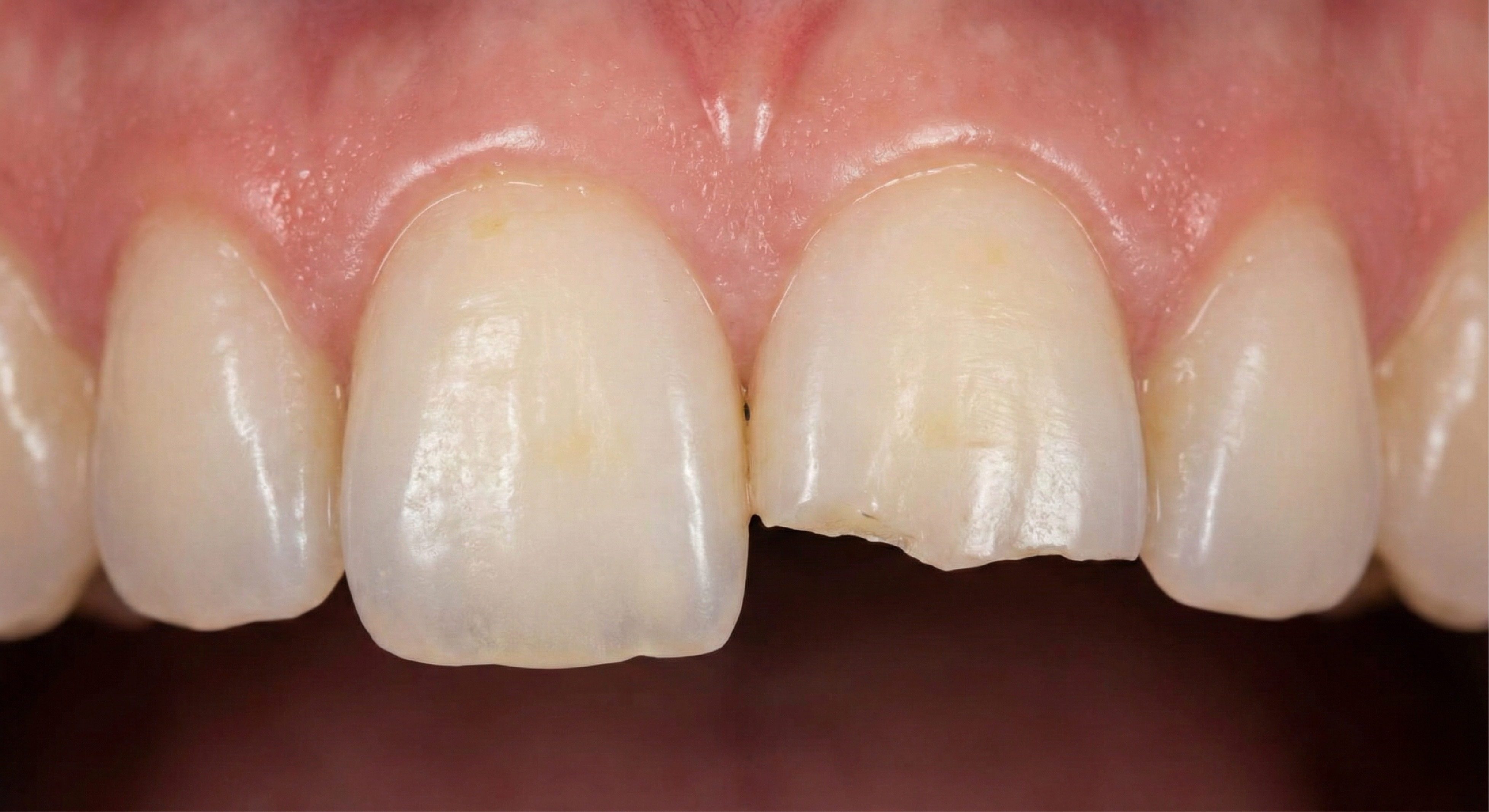 Before — Composite Bonding